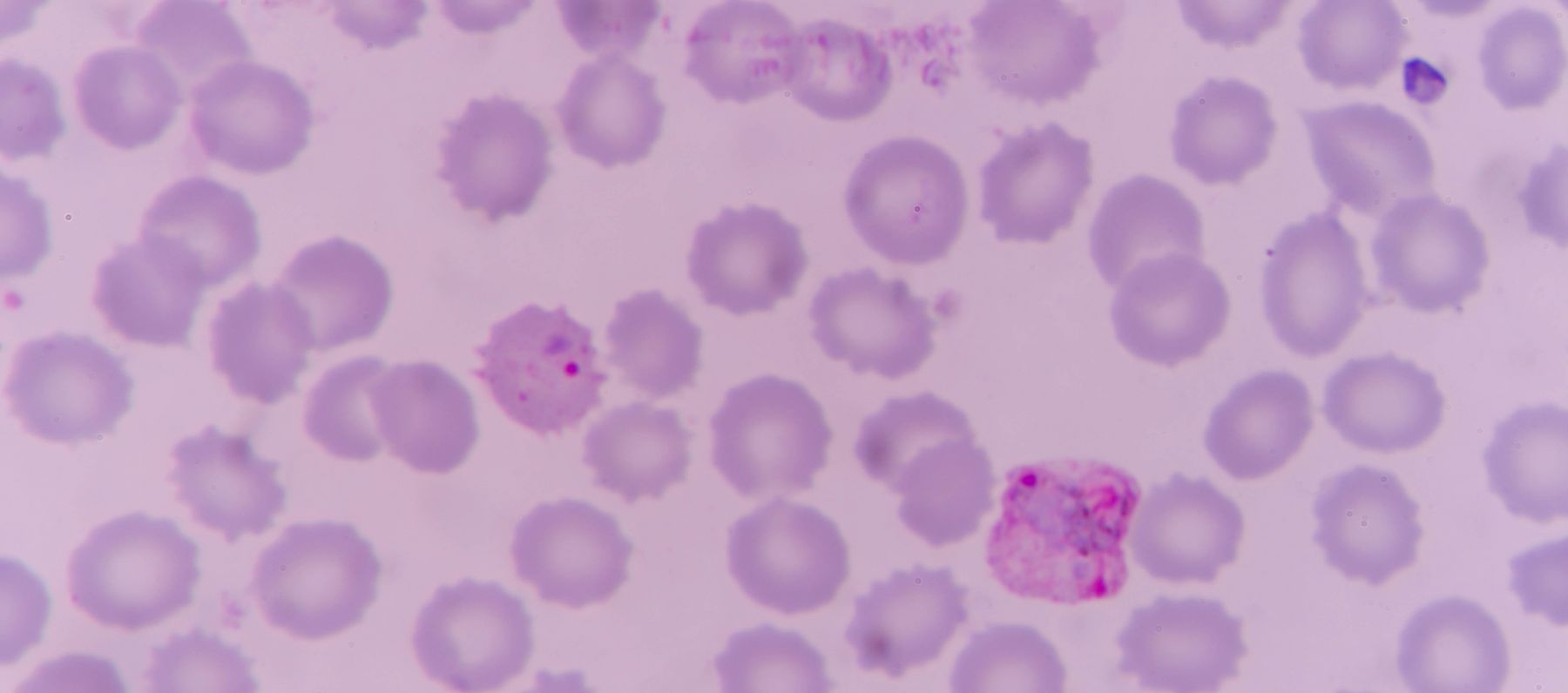 Malaria testing in Guyana